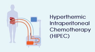 ஹைபர்தெர்மிக் இன்ட்ராபெரிட்டோனியல் கீமோதெரபி இன்போ கிராபிக்ஸ் HIPEC