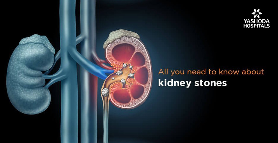 What you need to know about kidney stones