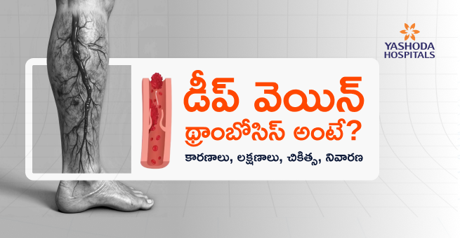 డీప్వెయిన్ థ్రాంబోసిస్ అంటే? కారణాలు, లక్షణాలు, చికిత్స, నివారణ