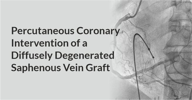 Percutaneous Coronary Intervention of A Diffusely Degenerated Saphenous Vein Graft