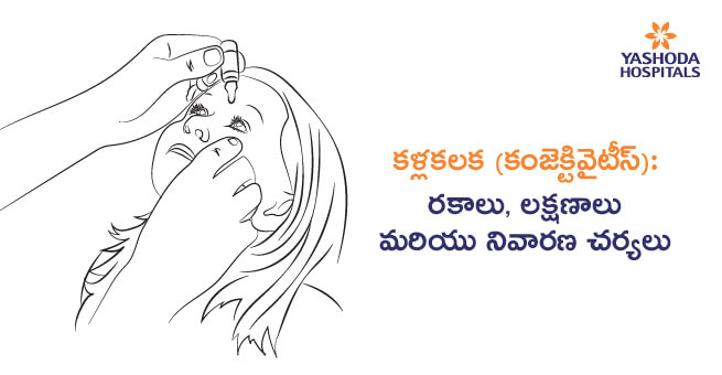 కళ్లకలక (కంజెక్టివైటీస్): రకాలు, లక్షణాలు మరియు నివారణ చర్యలు