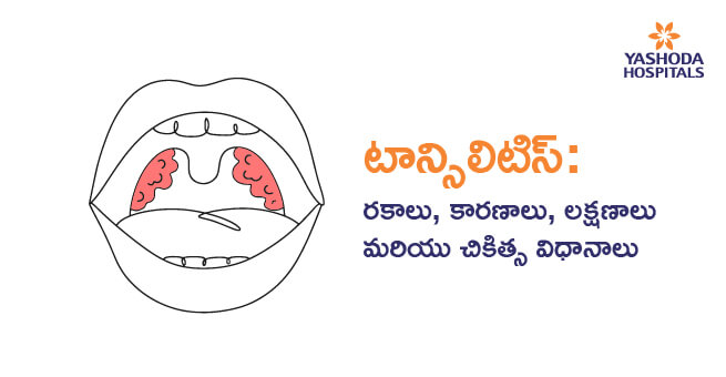 టాన్సిలిటిస్: రకాలు, కారణాలు, లక్షమరి ికిత్స విధానాలు
