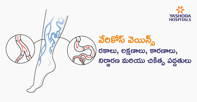 వేరికోస్వెయిన్స్రాకాలు, లక్షణాలకర, ిర్థారణ మరియు చికిత్స పద్దతులు