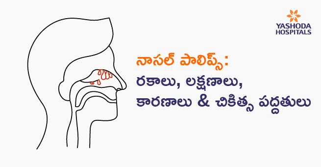 నాసల్ పాలిప్స్: రకాలు, లక్షణాలు, కాఁరరర చికిత్స పద్దతులు