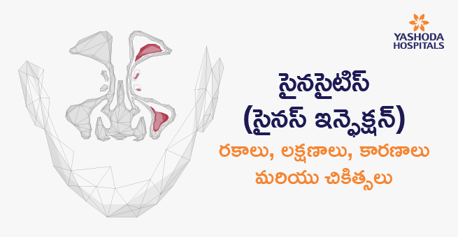 సైనసైటిస్ (సైనస్ ఇన్ఫెక్షన్): రకైాలు, లకకకకష ారణాలు మరియు చికిత్సలు