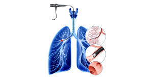 Interventsion pulmonologiyaning so'nggi yutuqlari Bronkoskopik termal bug 'ablatsiyasi (BTVA)