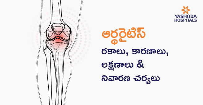ఆర్థరైటిస్ Main Banner