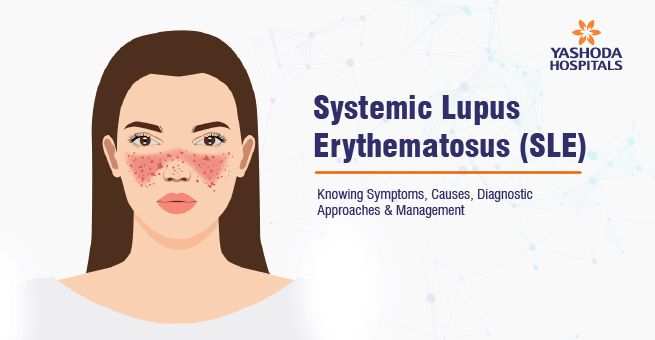 Systemic Lupus Erythematosus_Main Banner