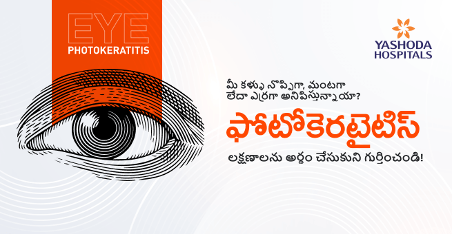 మీ కళ్ళు నొప్పిగా, మంటగా లేదా ఎర్రగా అనిపిస్తున్నాయా? ఫోటోకెరటైటిస్ లక్షణాలను అర్థం చేసుకుని గుర్తించండి!
