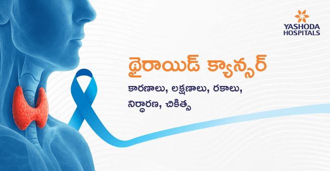 థైరాయిడ్ క్యాన్సర్, కారణాలు, లక్షణాలు, రకాలు, నిర్ధారణ, చికిత్స