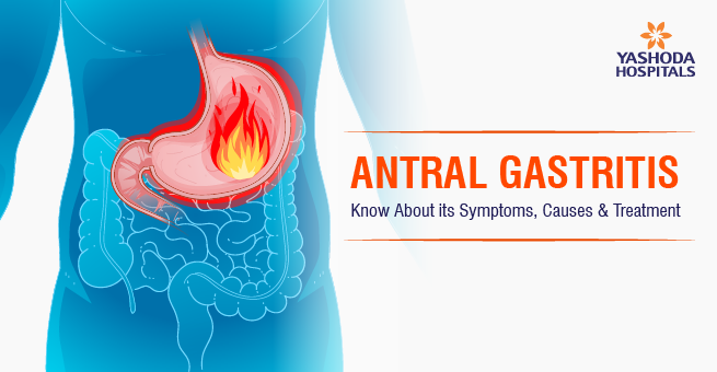Antral Gastritis - ၎င်း၏ရောဂါလက္ခဏာများ၊ အကြောင်းရင်းများနှင့်ကုသမှုအကြောင်းသိပါ။