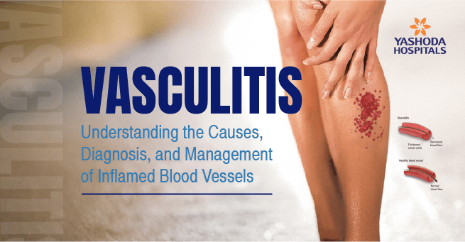 Vasculitis Main Banner