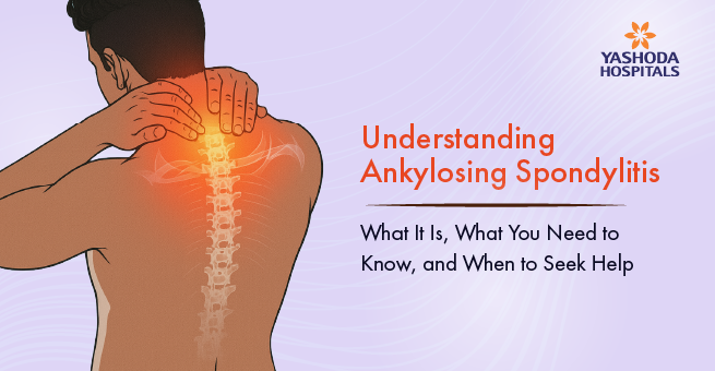 ankylosing spondylitis_Main