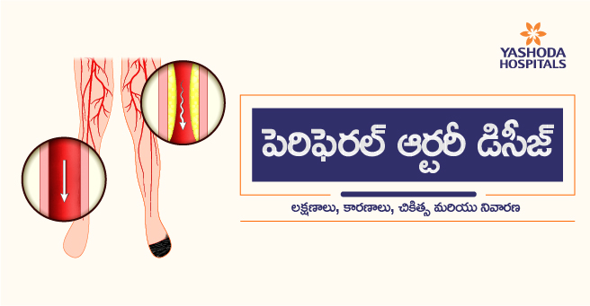 పెరిఫెరల్ ఆర్టరీ డిసీజ్ (PAD): లక్షణాలు, కారణాలు, చికిత్స మరియు నివారణ