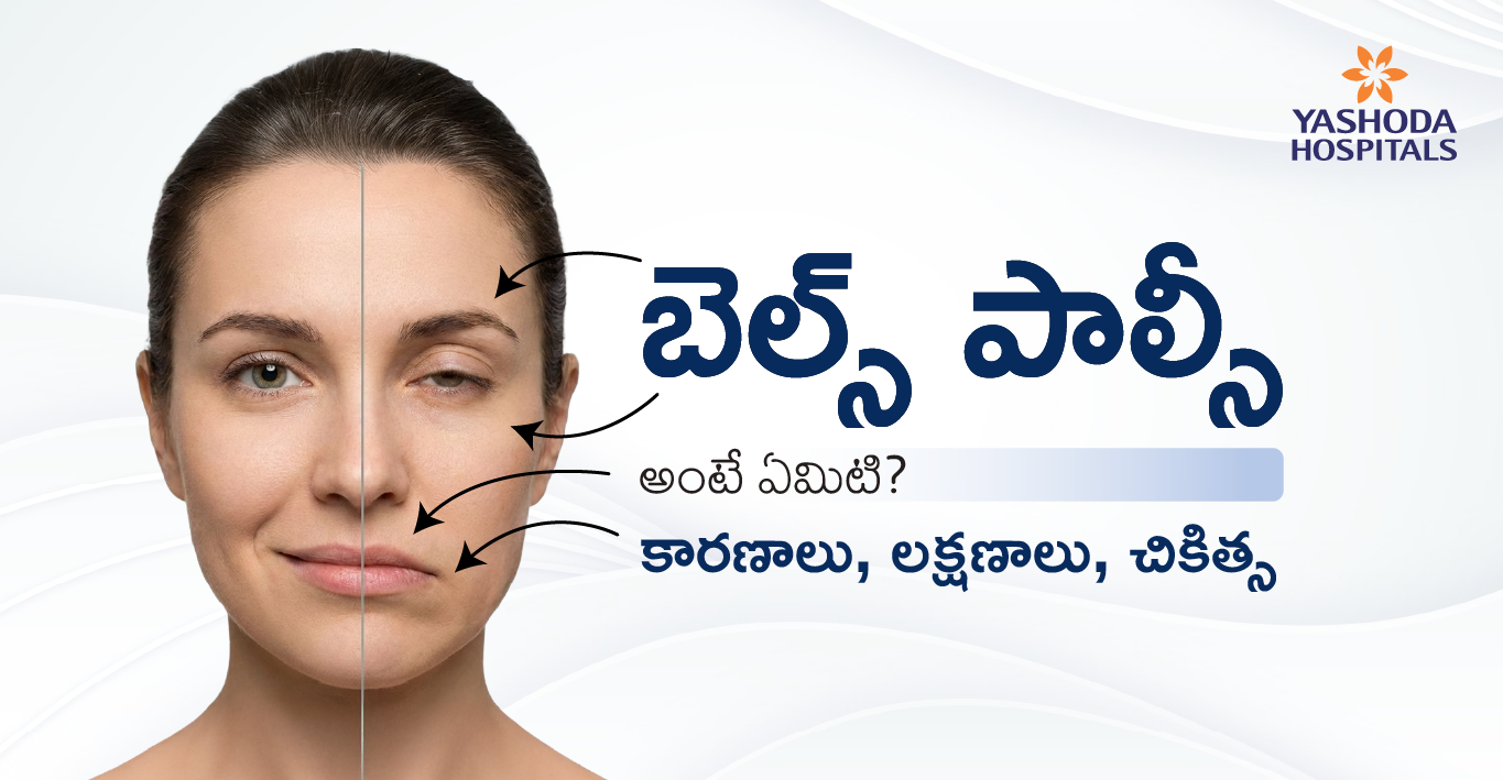 bell's-palsy