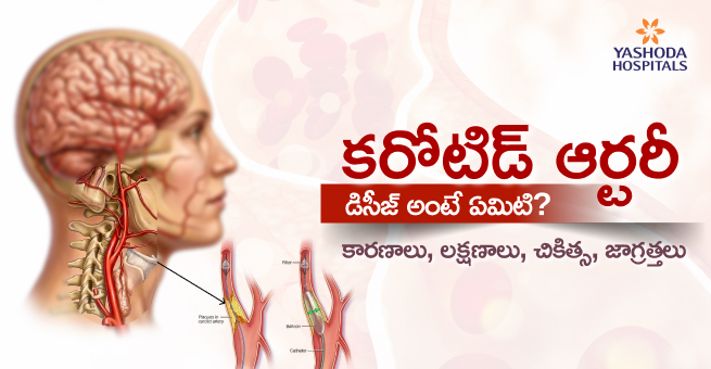 carotid-artery-disease