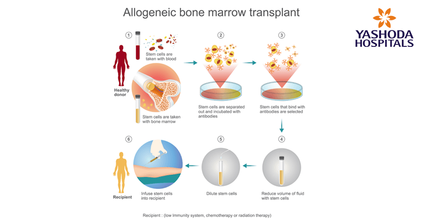 Allogenic stem cell transplant Allogenic stem cell transplant