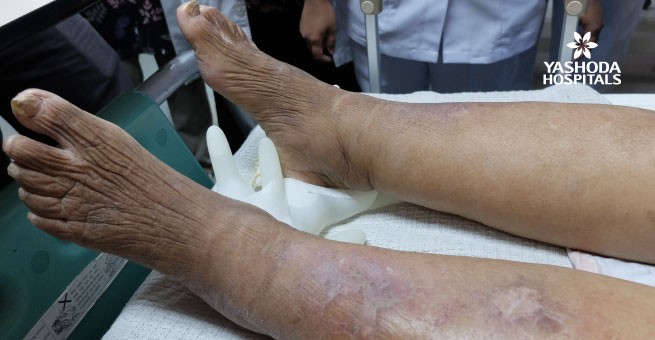நிணநீர் ஃபைலேரியாஸிஸ்