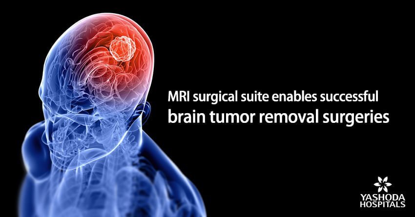 MRI surgical suite enables successful brain tumor removal surgeries MRI surgical suite enables successful brain tumor removal surgeries