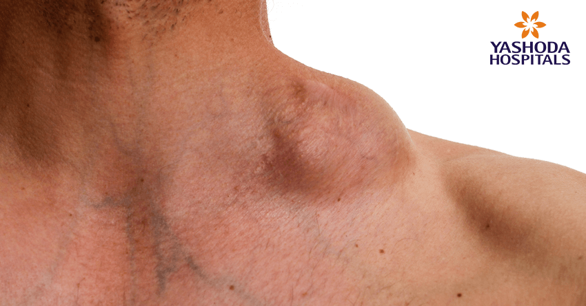Non-Hodgkin’s Lymphoma Non-Hodgkin’s Lymphoma