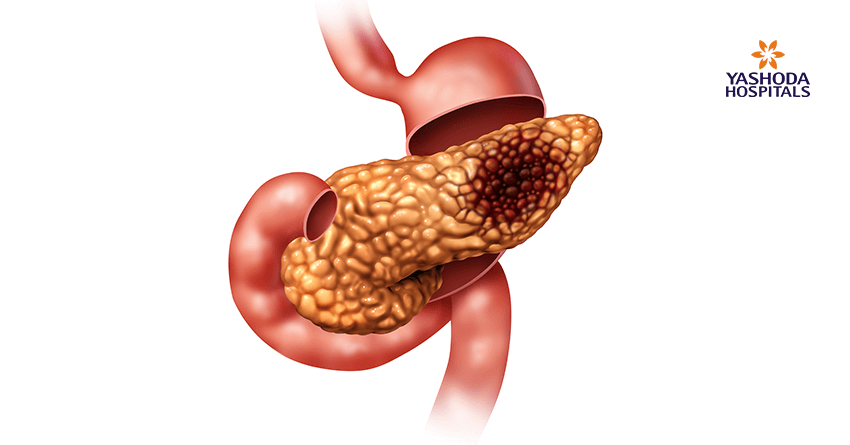 Pancreatic neuroendocrine carcinoma Pancreatic neuroendocrine carcinoma