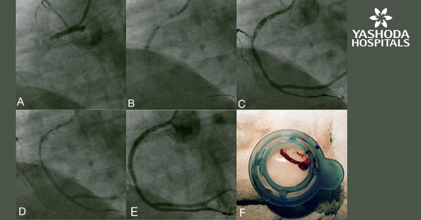 Primary angioplasty of a patient who presented with an acute inferior wall ST-elevation myocardial infarction. Primary angioplasty for Acute Myocardial infarction