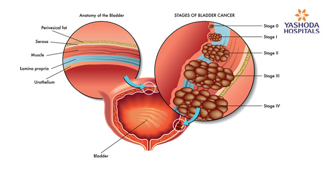 Risk factors for bladder cancer Risk factors for bladder cancer