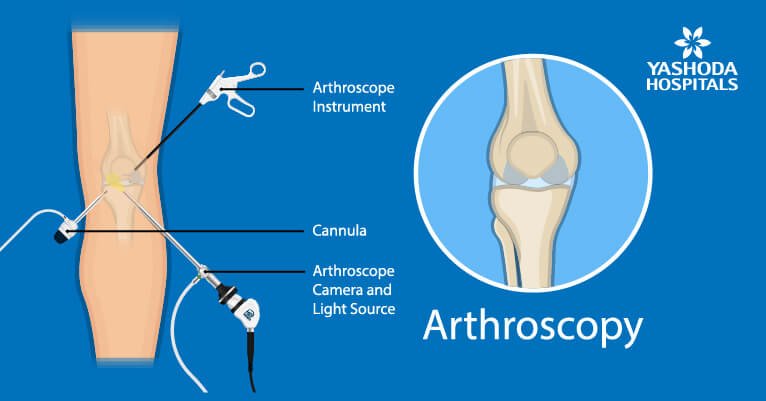 What is arthroscopic surgery What is arthroscopic surgery