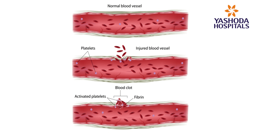 Primary angioplasty for Acute Myocardial infarction Primary angioplasty for Acute Myocardial infarction