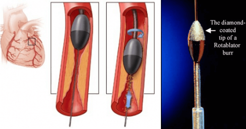 A special catheter, with an acorn-shaped, diamond-coated tip, is guided to the point of narrowing in your coronary artery. The tip spins around at a high speed and grinds away the plaque on your artery walls A special catheter, with an acorn-shaped, diamond-coated tip, is guided to the point of narrowing in your coronary artery. The tip spins around at a high speed and grinds away the plaque on your artery walls