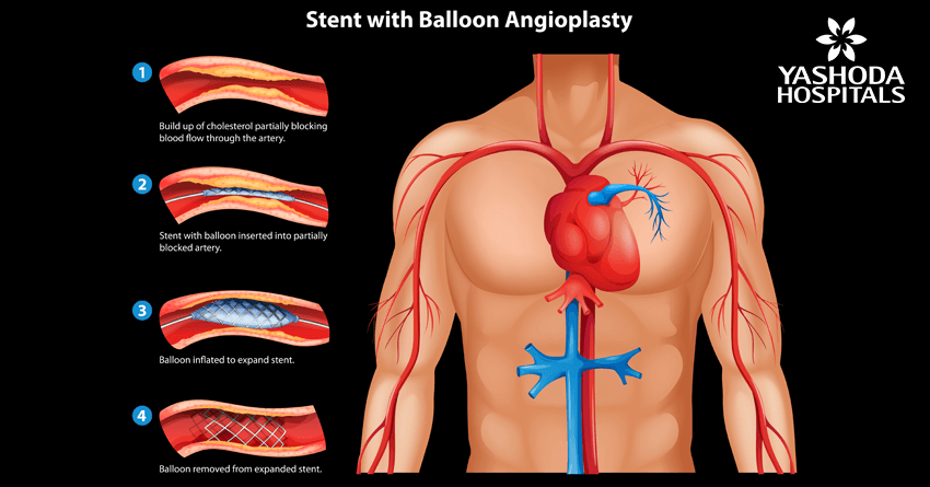 Primary angioplasty for Acute Myocardial infarction Primary angioplasty for Acute Myocardial infarction