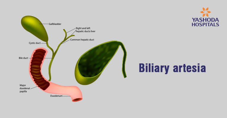 What are the causes of biliary atresia What are the causes of biliary atresia