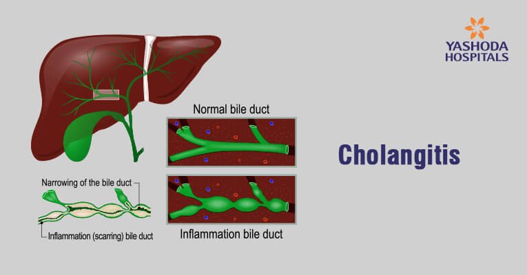 What are the complications of biliary atresia What are the complications of biliary atresia