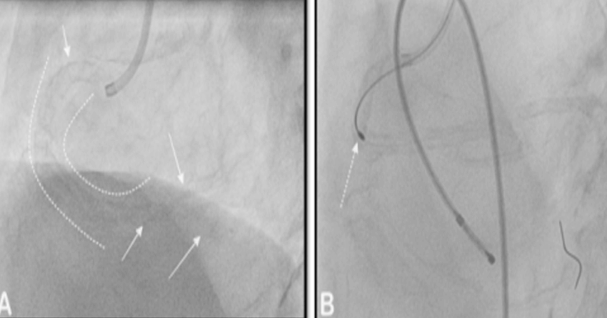 Panel A: The curved dashed lines across the entire course of the right coronary artery depicting the presence of the calcium, which posed difficulty in crossing the artery. Panel B : the use of Rotablation for debulking the calcium from the lesion. The Rota burr is seen crossing the vessel under the presence of temporary pacemaker wire as a stand by if patient develops heart blocks leading to low heart rate Panel A: The curved dashed lines across the entire course of the right coronary artery depicting the presence of the calcium, which posed difficulty in crossing the artery. Panel B : the use of Rotablation for debulking the calcium from the lesion. The Rota burr is seen crossing the vessel under the presence of temporary pacemaker wire as a stand by if patient develops heart blocks leading to low heart rate