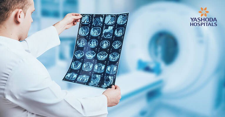 Encephalitis-brain fever outbreak Encephalitis-brain fever outbreak