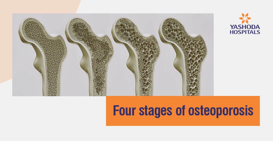 four stages of osteoporosis four stages of osteoporosis