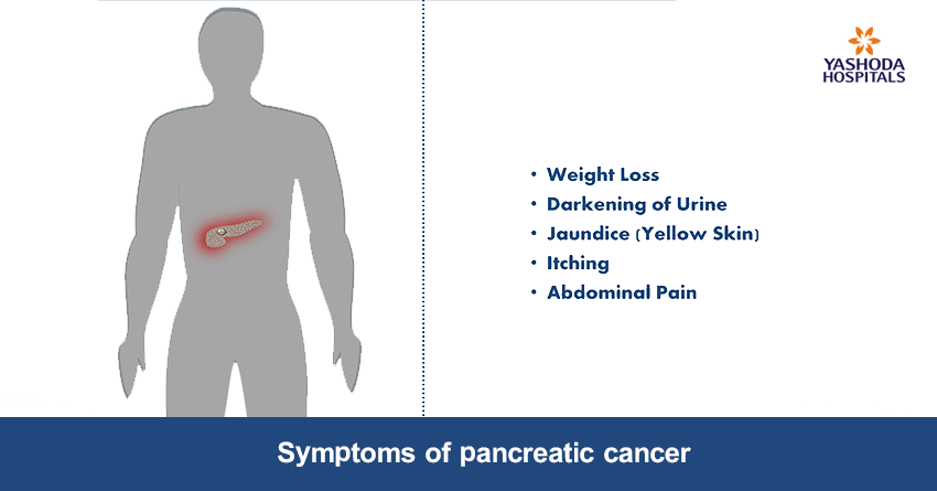 signs & symptoms of pancreatic cancer signs & symptoms of pancreatic cancer