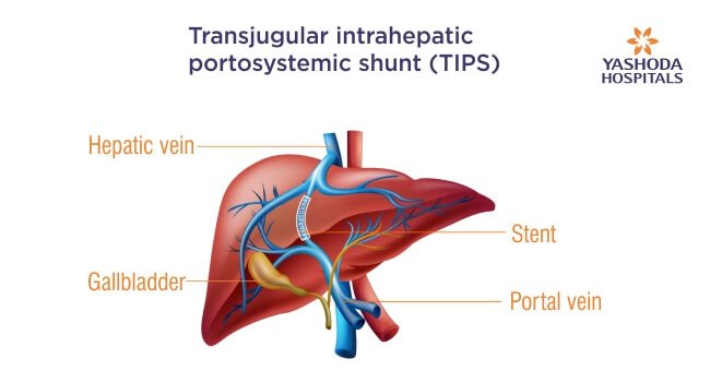 Portal hypertension and TIPS (Transjugular Intrahepatic Portosystemic Shunt) Portal hypertension and TIPS (Transjugular Intrahepatic Portosystemic Shunt)