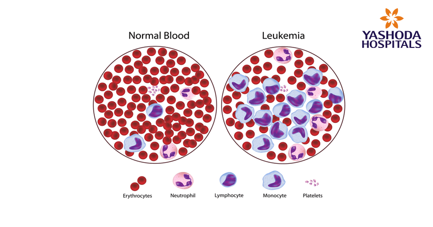types of blood cancers-leukaemia-lymphoma-myeloma types of blood cancers-leukaemia-lymphoma-myeloma