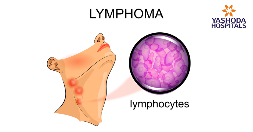types of blood cancers-lymphoma types of blood cancers-lymphoma