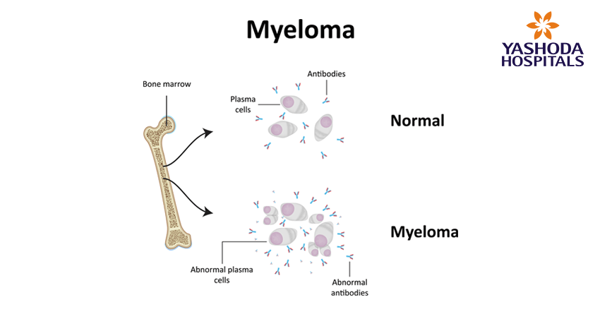 types of blood cancers-myeloma types of blood cancers-myeloma
